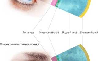 Как вылечить синдром сухого глаза