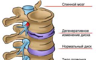 Как лечить остеохондроз корешковый синдром