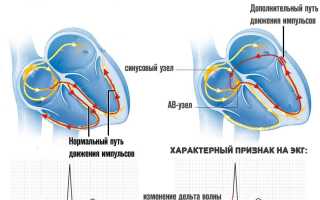 Синдром впв и редкий пульс