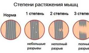Растяжение мышц руки код мкб