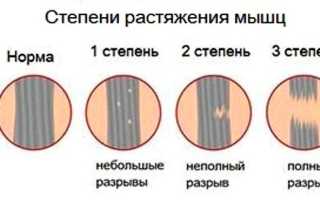 Растяжение мышц руки код мкб
