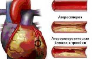 Острый коронарный синдром с подъемом