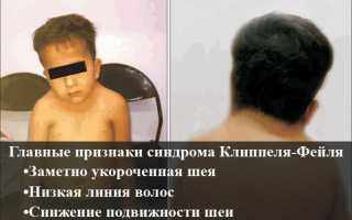Синдром клиппеля фейля у детей