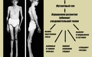 Синдром марфана только по наследству