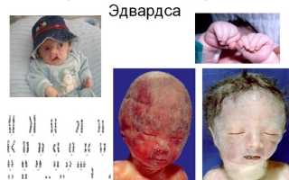 Новорожденные дети с синдромом эдвардса фото