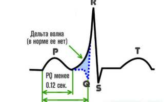 Заключение экг синдром укороченного pq