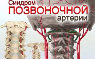 Синдром позвоночной артерии и профилактика
