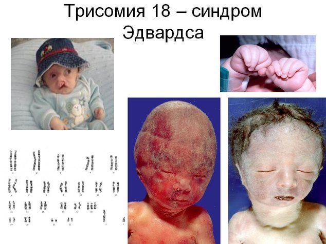 Новорожденные дети с синдромом эдвардса фото