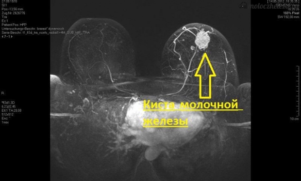 Киста молочной железы на мрт