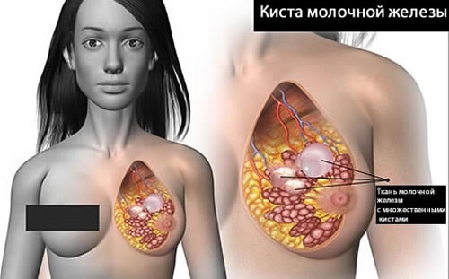 Симптомы кисты молочной железы
