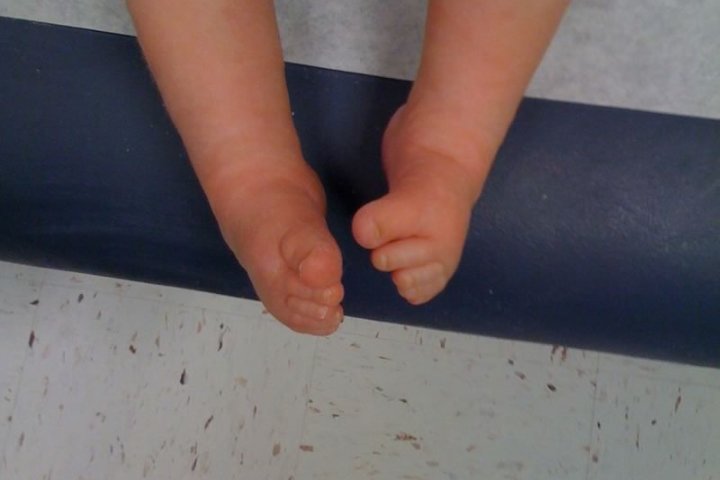 Эквиноварусная деформация стопы код мкб