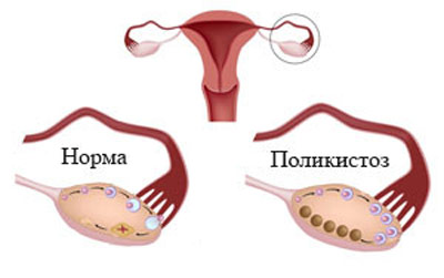 дисфункция яичников что это 