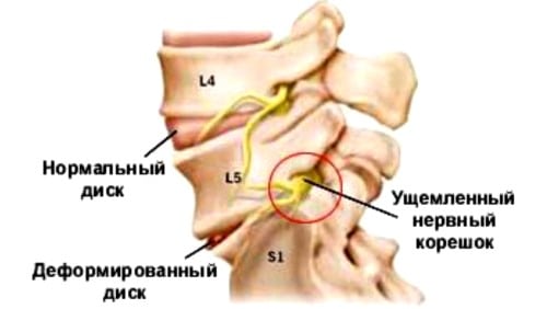 Корешковый синдром при остеохондрозе поясничного отдела