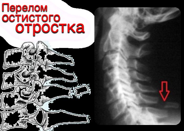 Перелом тела позвонка код мкб