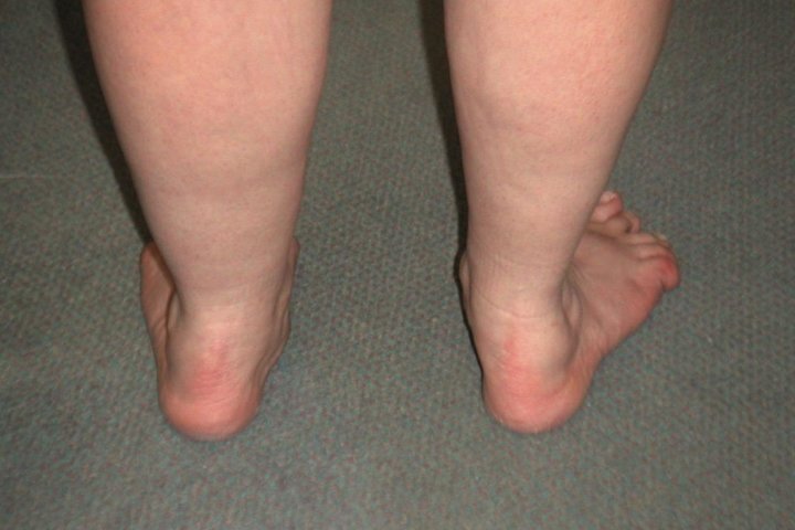 Плоско вальгусная стопа у ребенка код по мкб 10