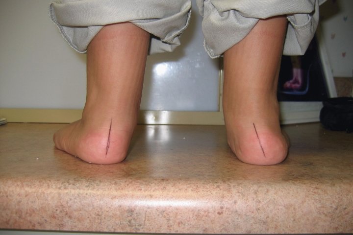 Эквиноварусная деформация стопы код мкб