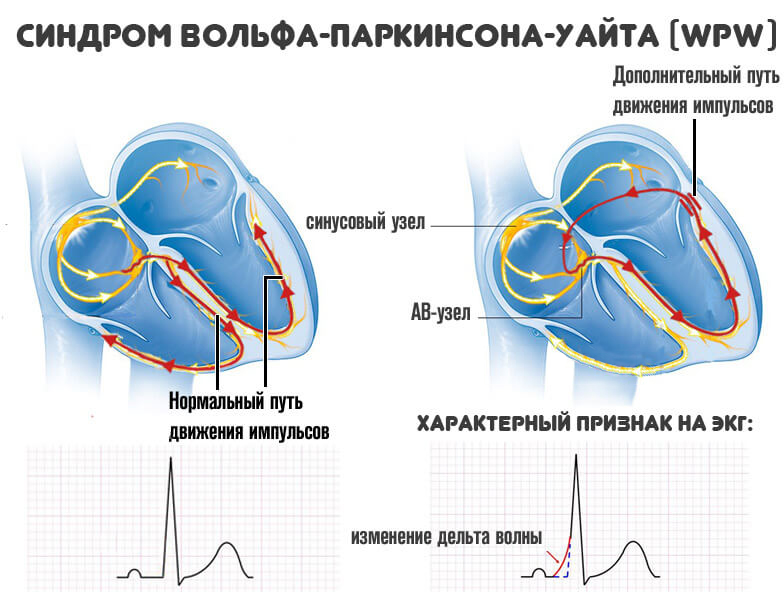 Синдром впв и редкий пульс