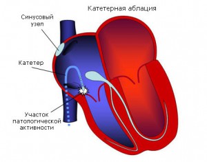 Заключение экг синдром укороченного pq