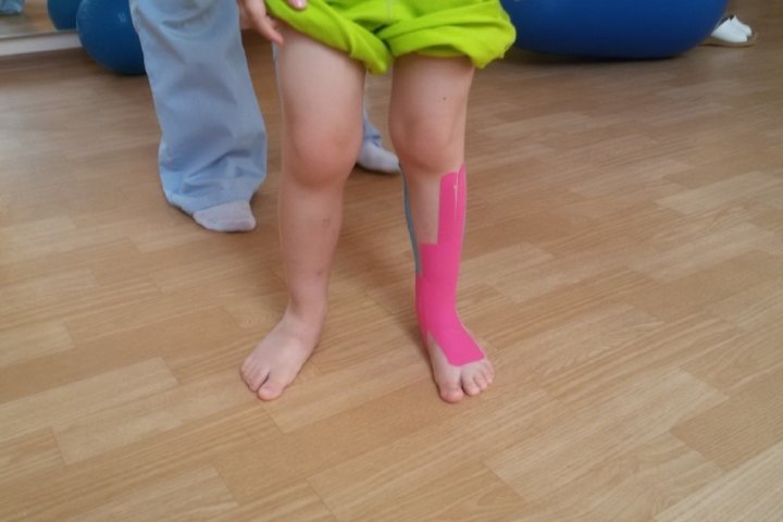 Эквиноварусная деформация стопы код мкб