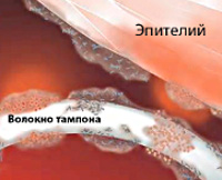 Синдром токсического шока