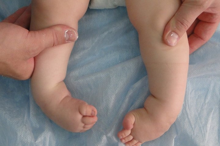 Эквиноварусная деформация стопы код мкб