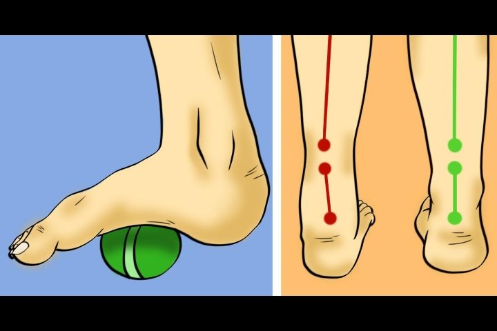 Эквиноварусная деформация стопы код мкб