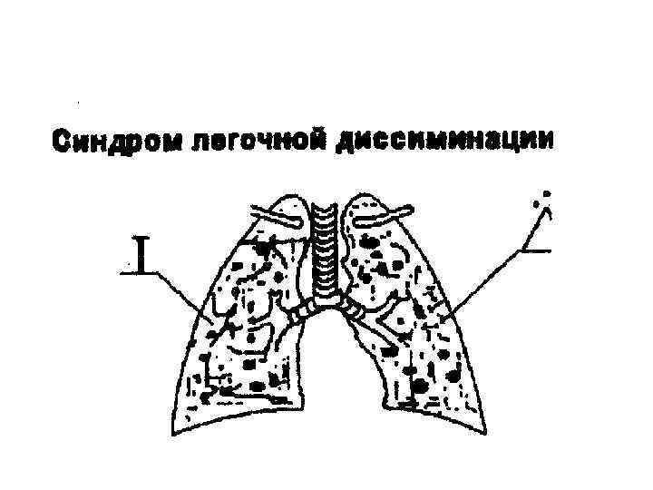 Синдром снижения воздушности легочной ткани