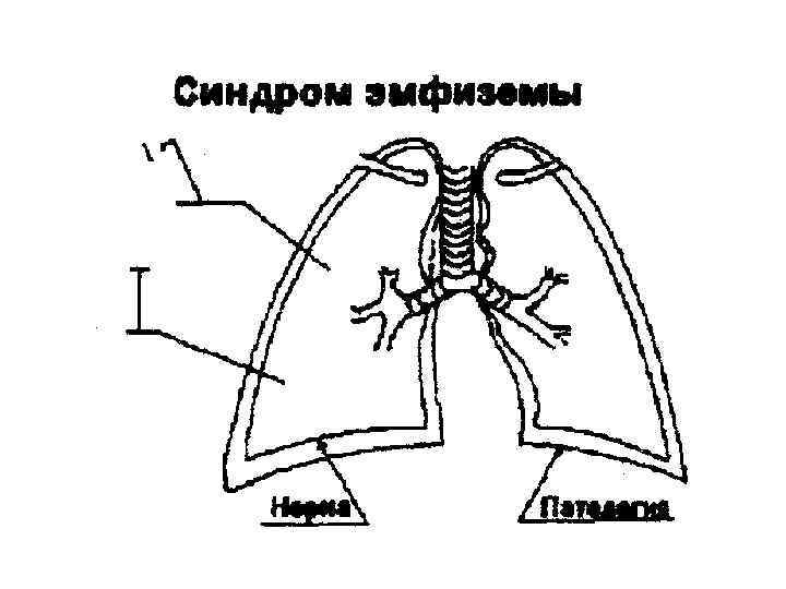 Синдром снижения воздушности легочной ткани