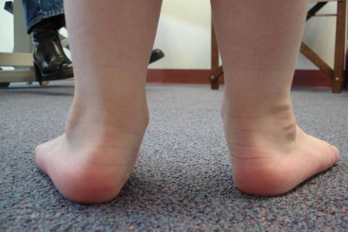 Плоско вальгусная стопа у ребенка код по мкб 10