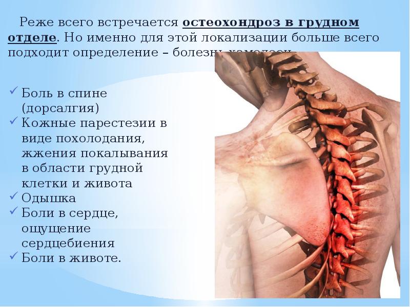 Корешковый синдром при остеохондрозе поясничного отдела