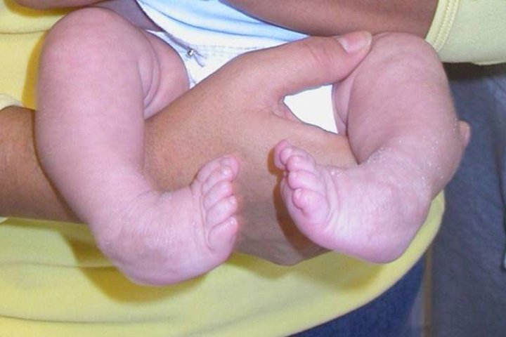 Эквиноварусная деформация стопы код мкб