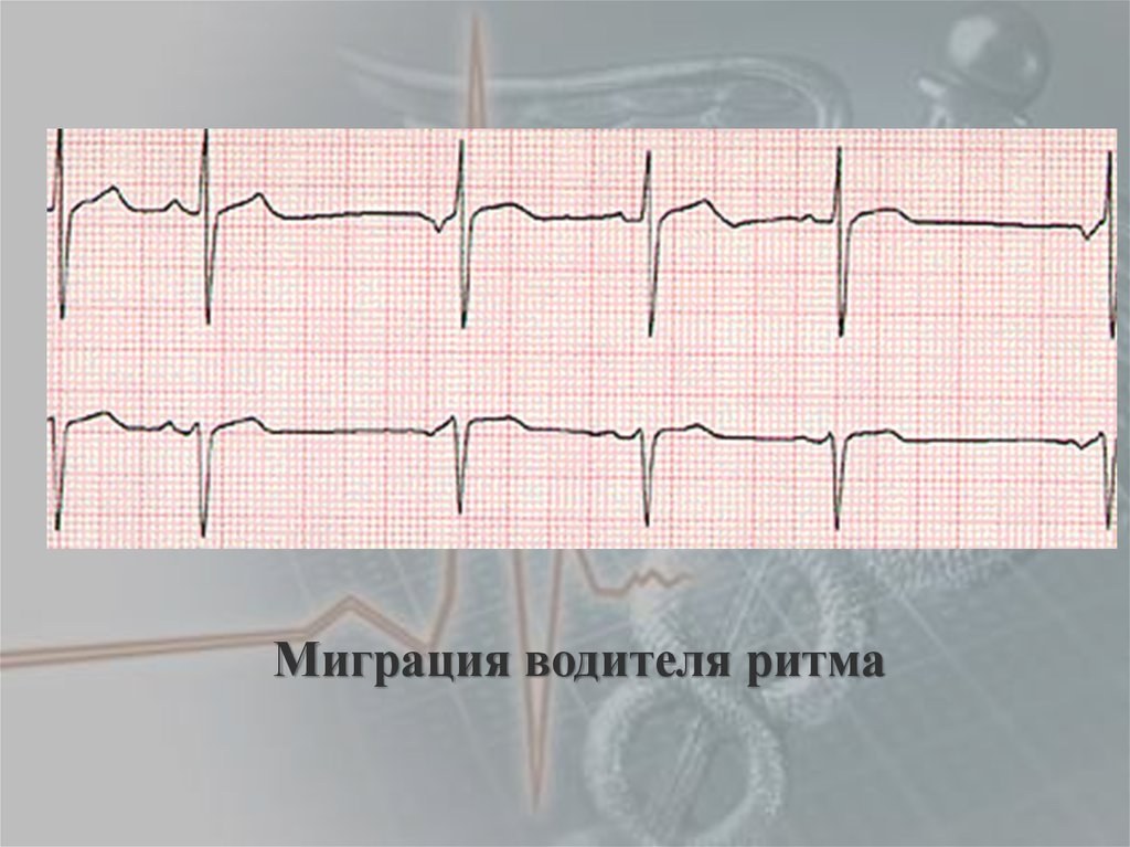 Миграция водителя ритма по предсердиям код мкб