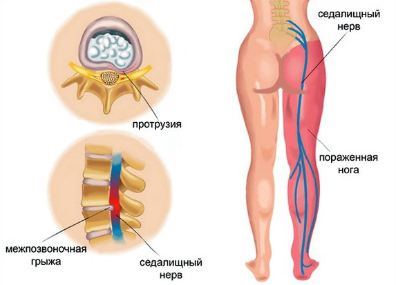 Снятие болевого синдрома при защемлении седалищного нерва
