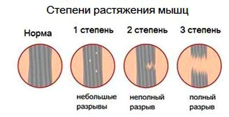 Растяжение мышц руки код мкб