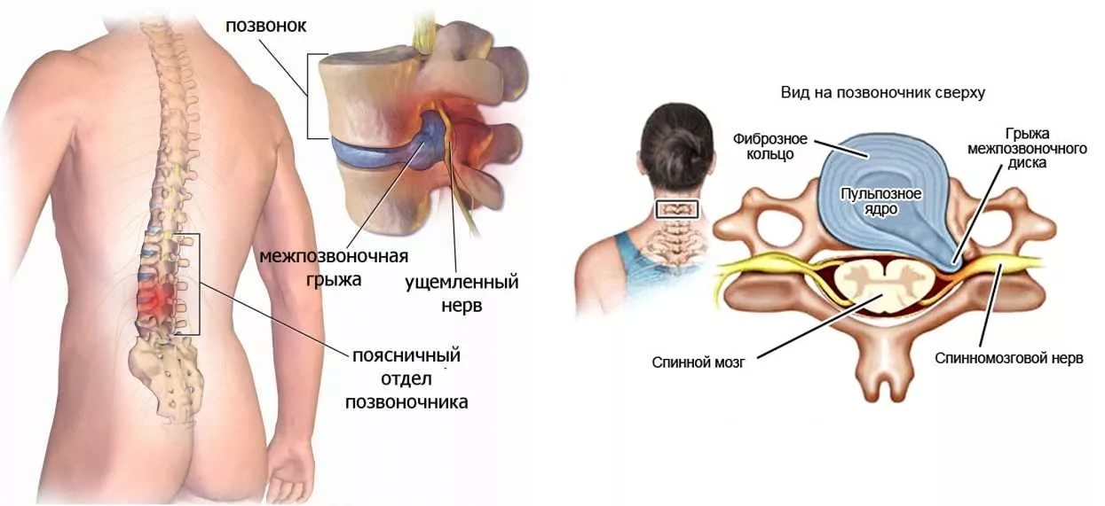 рис 4 дорсопатия поясничного отдела