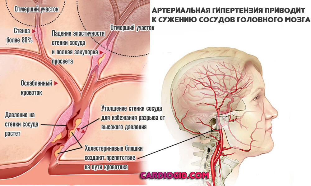 Энцефалопатия на фоне гипертензионного синдрома