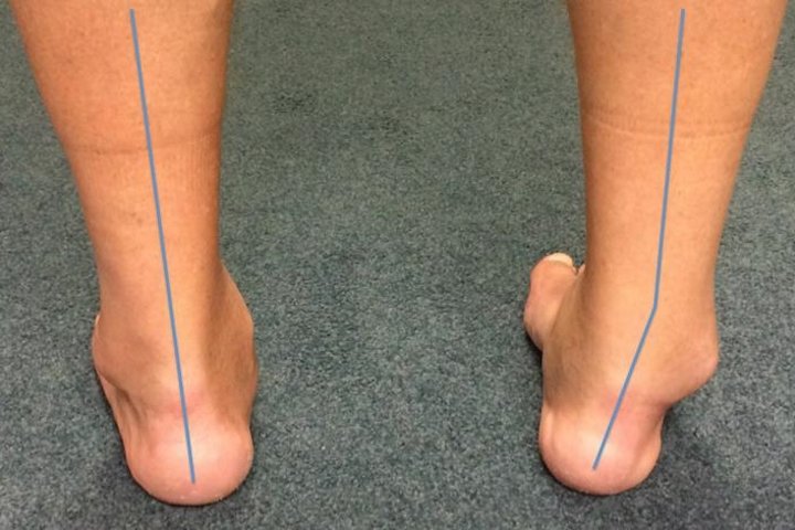 Эквиноварусная деформация стопы код мкб