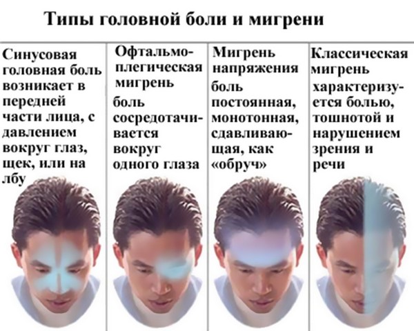 типы голоной боли при мигрени