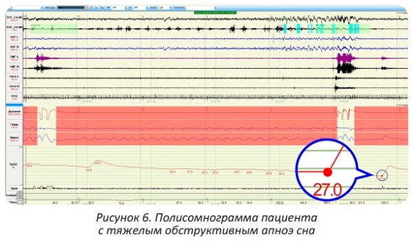 Как лечить храп и синдром обструктивного апноэ сна