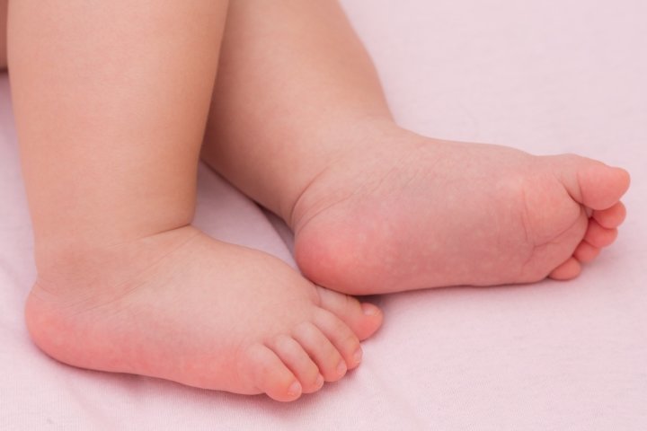 Плоско вальгусная стопа у ребенка код по мкб 10